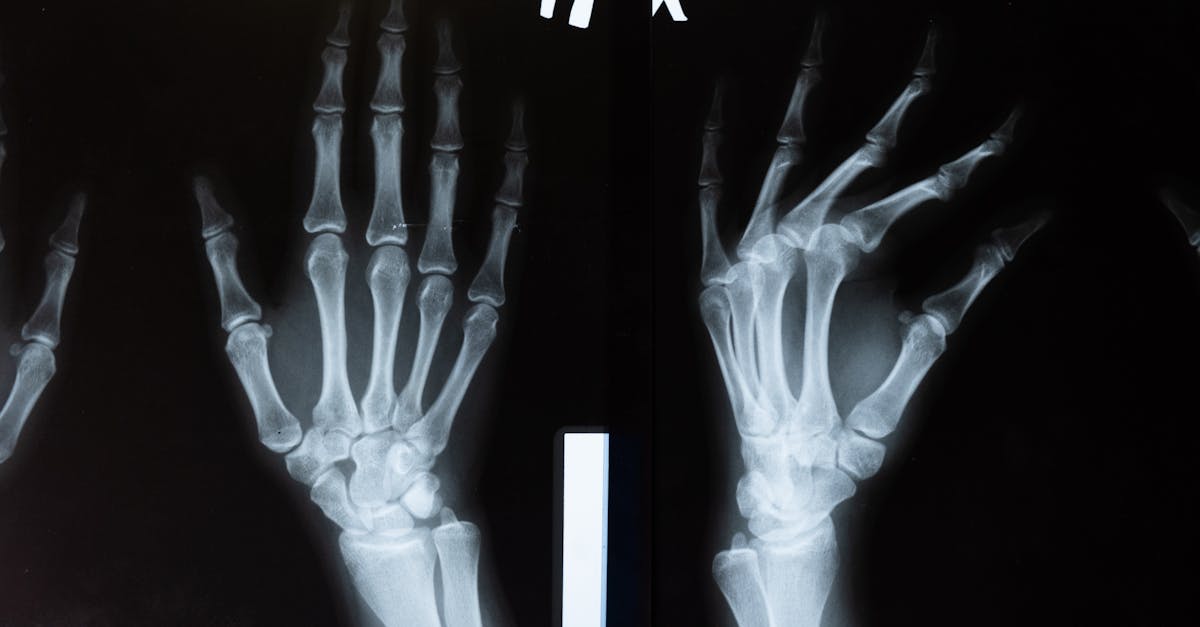 découvrez comment tildren aide à traiter les maladies osseuses chez les chevaux, en améliorant leur santé et leur mobilité grâce à une solution efficace et adaptée.