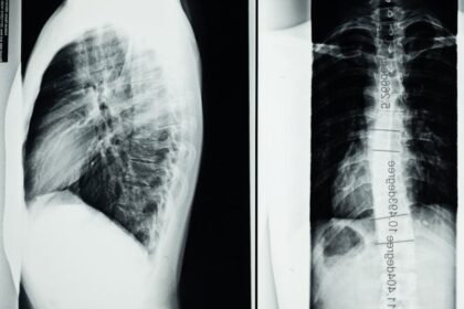 découvrez comment tildren aide à traiter les maladies osseuses chez les chevaux, améliorant leur santé et leur mobilité grâce à une action ciblée.